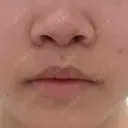 人中短縮 / 目尻切開 / タレ目形成・グラマラスライン（切開） / ボトックス（人中） / その他（鼻） ルラ美容クリニック 大阪本院 DAY 10 サムネイル用