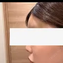 脂肪注入（額） / ヒアルロン酸溶解 ルーチェクリニック 銀座院 DAY 0 サムネイル用