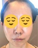 糸リフト 湘南美容クリニック 岡山院 AFTER サムネイル用
