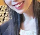 脂肪溶解注射（顔） B-LINE CLINIC 大阪院 AFTER サムネイル用