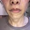 人中短縮 / 口角挙上 / その他（口元） ルラ美容クリニック 神戸院 DAY 6 サムネイル用