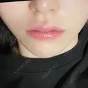 ボトックス（あご） / 肌ヒアルロン酸注入（たるみ・シワ改善） / ヒアルロン酸注入（唇） / ヒアルロン酸注入（鼻翼基部） 札幌TAクリニック DAY 0 サムネイル用