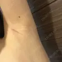 豊胸（シリコン＋脂肪併用） MYCLI【マイクリ】東京・恵比寿院 DAY 149 サムネイル用