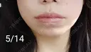 ヒアルロン酸注入（唇） Tokyo Tensei Clinic 新宿院 DAY 13 サムネイル用