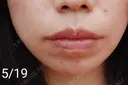 ヒアルロン酸注入（唇） Tokyo Tensei Clinic 新宿院 DAY 18 サムネイル用