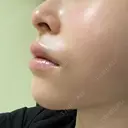 ボトックス（あご） / 肌ヒアルロン酸注入（たるみ・シワ改善） / ヒアルロン酸注入（唇） / ヒアルロン酸注入（鼻翼基部） 札幌TAクリニック DAY 1 サムネイル用