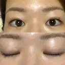 上まぶたの脂肪取り 9BeautyClinic AFTER サムネイル用