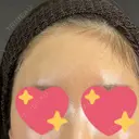 ヒアルロン酸注入（額） 藤・ナチュレ美容クリニック 銀座院 AFTER サムネイル用