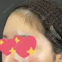 ヒアルロン酸注入（額） 藤・ナチュレ美容クリニック 銀座院 DAY 7 サムネイル用