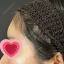 ヒアルロン酸注入（額） 藤・ナチュレ美容クリニック 銀座院 DAY 7 サムネイル用