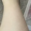 ほくろ・いぼ除去レーザー（肌） 心斎橋KT美容クリニック AFTER サムネイル用