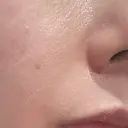 ボトックス（エラ・小顔） / その他（口元） 共立美容外科 福岡院 AFTER サムネイル用