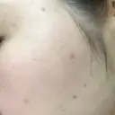 ほくろ・いぼ切除（肌） リメイ皮膚科 DAY 7 サムネイル用