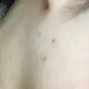 ほくろ・いぼ切除（肌） リメイ皮膚科 DAY 7 サムネイル用