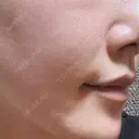 ピーリング（ニキビ・毛穴） Re:anne clinic 銀座 【リアンクリニック銀座】 AFTER サムネイル用