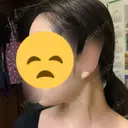 ボトックス（エラ・小顔） / 脂肪溶解注射（顔） リエンジャン整形外科 江南店 DAY 8 サムネイル用