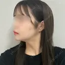 骨切り（あご） / 骨削り（エラ） / 骨削り（頬） / バッカルファット除去 / 脂肪吸引（顔） バタン美容整形外科 DAY 203 サムネイル用