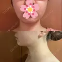 糸リフト / 脂肪吸引（顔） EMMA CLINIC（エマクリニック） DAY 31 サムネイル用