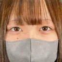 目頭切開 ネビュラクリニック 京都院 DAY 46 サムネイル用
