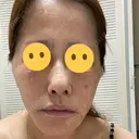 糸リフト / クマ治療 / 下まぶたの脂肪取り 湘南美容クリニック 千葉センシティ院 DAY 1 サムネイル用