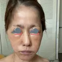 糸リフト / クマ治療 / 下まぶたの脂肪取り 湘南美容クリニック 千葉センシティ院 DAY 2 サムネイル用