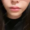 ボトックス（あご） / 肌ヒアルロン酸注入（たるみ・シワ改善） / ヒアルロン酸注入（唇） / ヒアルロン酸注入（鼻翼基部） 札幌TAクリニック AFTER サムネイル用