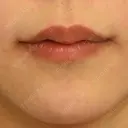 目頭切開 / 脂肪吸引（顔） / 目尻切開 / 脂肪注入（肌） / 脂肪注入（額） / 口角挙上 / メーラーファット除去 / タレ目形成・グラマラスライン（埋没） / 脂肪注入（輪郭） 札幌ル・トロワ ビューティクリニックVogue DAY 7 サムネイル用