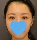 目頭切開 / 脂肪吸引（顔） / 目尻切開 / 脂肪注入（肌） / 脂肪注入（額） / 口角挙上 / メーラーファット除去 / タレ目形成・グラマラスライン（埋没） / 脂肪注入（輪郭） 札幌ル・トロワ ビューティクリニックVogue AFTER サムネイル用