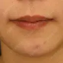 目頭切開 / 脂肪吸引（顔） / 目尻切開 / 脂肪注入（肌） / 脂肪注入（額） / 口角挙上 / メーラーファット除去 / タレ目形成・グラマラスライン（埋没） / 脂肪注入（輪郭） 札幌ル・トロワ ビューティクリニックVogue DAY 71 サムネイル用