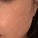 ボトックス（エラ・小顔） / ルメッカ Code Beauty Clinic 名古屋院 DAY 1 サムネイル用
