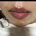 肌ヒアルロン酸注入（たるみ・シワ改善） TCB東京中央美容外科 姫路院 AFTER サムネイル用