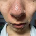 その他（鼻） / アグネス フェアクリニック川口 DAY 9 サムネイル用
