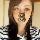 切開リフト 東京エビスクリニック DAY 5 サムネイル用