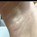 ワキ汗治療（レーザー） Fellez Clinic【フェルズクリニック】 AFTER サムネイル用