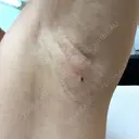 ワキ汗治療（レーザー） Fellez Clinic【フェルズクリニック】 DAY 108 サムネイル用