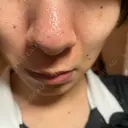 その他（鼻） / アグネス フェアクリニック川口 AFTER サムネイル用