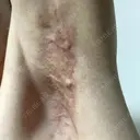 ワキ汗治療（切開） 石倉クリニック 水戸院 DAY 94 サムネイル用