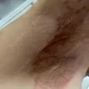 ワキ汗治療（切開） 石倉クリニック 水戸院 DAY 94 サムネイル用