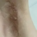 ワキ汗治療（切開） 石倉クリニック 水戸院 DAY 101 サムネイル用