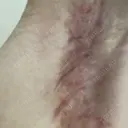 ワキ汗治療（切開） 石倉クリニック 水戸院 DAY 101 サムネイル用