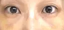 その他（目元） / クマ治療 / 下まぶたたるみ取り / 下まぶたの脂肪取り お茶の水美容形成クリニック DAY 5 サムネイル用
