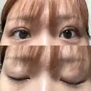 二重埋没 ROOTS Clinic AFTER サムネイル用
