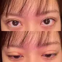 二重埋没 湘南美容クリニック 博多院 DAY 2 サムネイル用