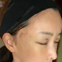 切開リフト 東京エビスクリニック DAY 7 サムネイル用