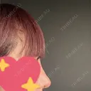 隆鼻術 / 鼻尖形成（切開） / 鼻中隔延長（切開） / 軟骨移植 R Beauty CLINIC 銀座院 AFTER サムネイル用