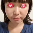 糸リフト / 脂肪吸引（顔） / メーラーファット除去 BLINC CLINIC （ブリンク クリニック） DAY 4 サムネイル用