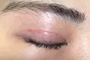 二重切開 / 眼瞼下垂（切開） オーキッド美容クリニック東京御徒町 DAY 26 サムネイル用
