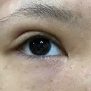 二重埋没 東京皮膚科・形成外科 (銀座いけだクリニック) DAY 3 サムネイル用