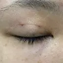 二重埋没 東京皮膚科・形成外科 (銀座いけだクリニック) DAY 3 サムネイル用