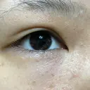二重埋没 東京皮膚科・形成外科 (銀座いけだクリニック) DAY 29 サムネイル用
